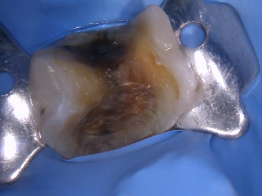 2-inlay-onlay-dentiste-beausoleil